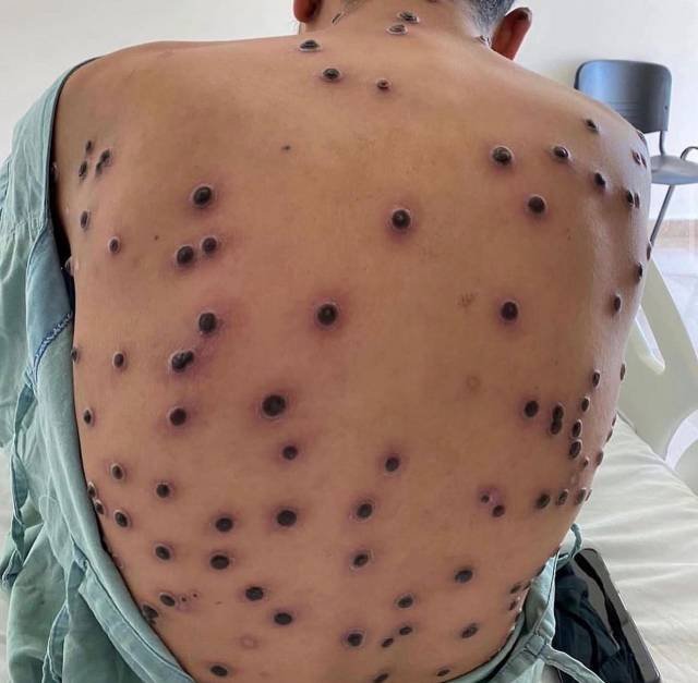 Paraná registra primeiro caso do vírus mpox do ano, diz Secretaria de Saúde